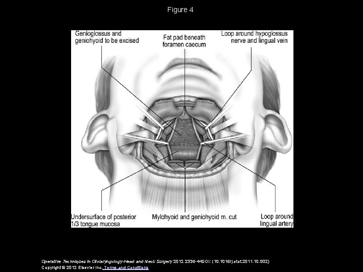 Figure 4 Operative Techniques in Otolaryngology-Head and Neck Surgery 2012 2336 -44 DOI: (10.
