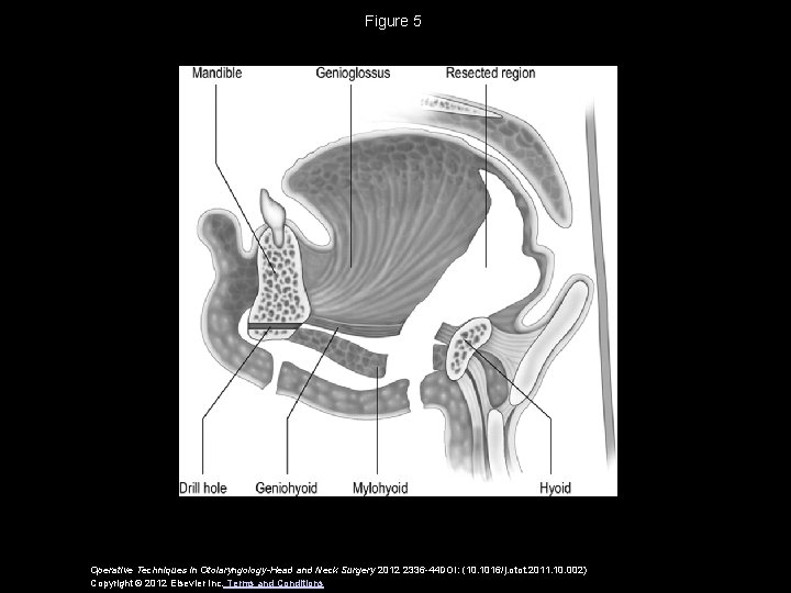 Figure 5 Operative Techniques in Otolaryngology-Head and Neck Surgery 2012 2336 -44 DOI: (10.