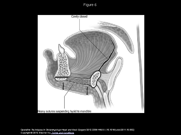 Figure 6 Operative Techniques in Otolaryngology-Head and Neck Surgery 2012 2336 -44 DOI: (10.
