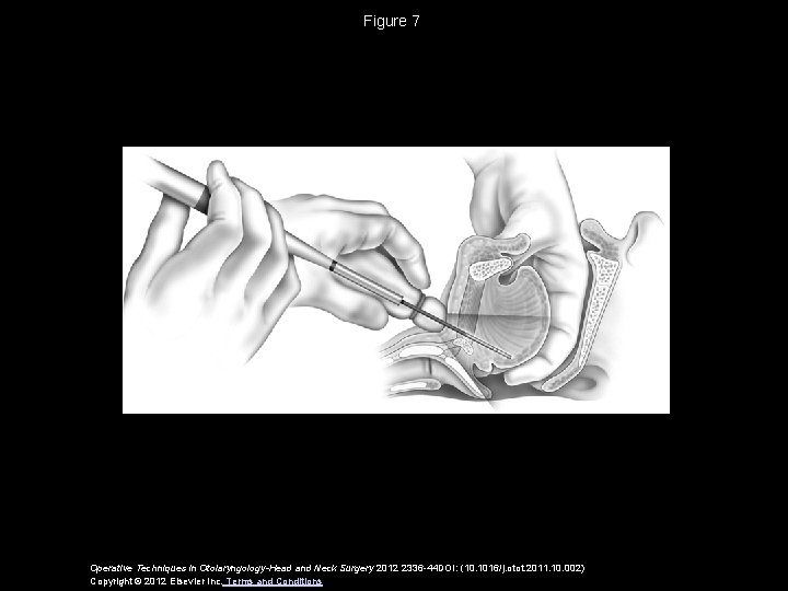 Figure 7 Operative Techniques in Otolaryngology-Head and Neck Surgery 2012 2336 -44 DOI: (10.