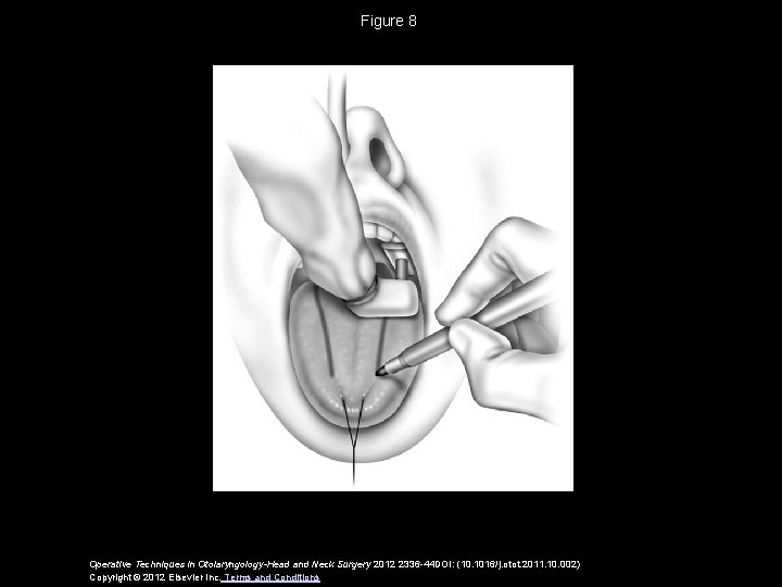 Figure 8 Operative Techniques in Otolaryngology-Head and Neck Surgery 2012 2336 -44 DOI: (10.