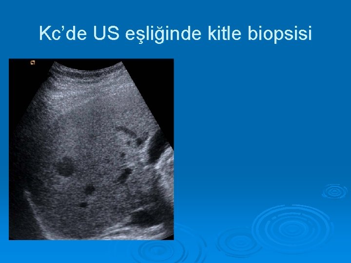 Kc’de US eşliğinde kitle biopsisi 