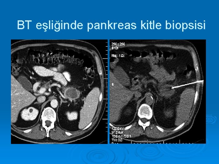 BT eşliğinde pankreas kitle biopsisi 
