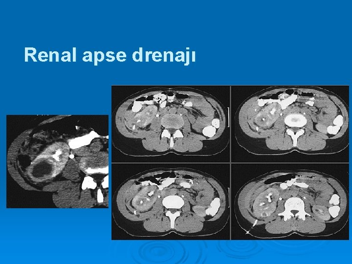 Renal apse drenajı 