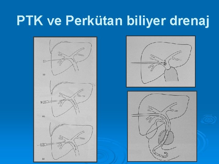 PTK ve Perkütan biliyer drenaj 