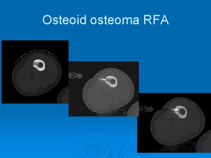 Osteoid osteoma RFA 