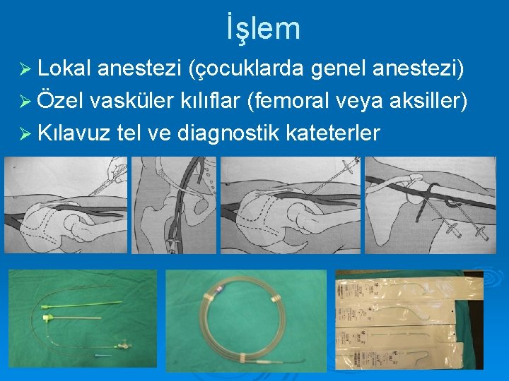 İşlem Ø Lokal anestezi (çocuklarda genel anestezi) Ø Özel vasküler kılıflar (femoral veya aksiller)