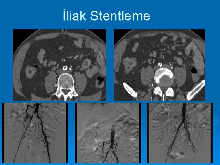 İliak Stentleme 