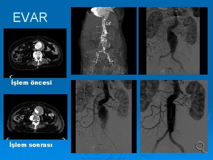 EVAR İşlem öncesi İşlem sonrası 
