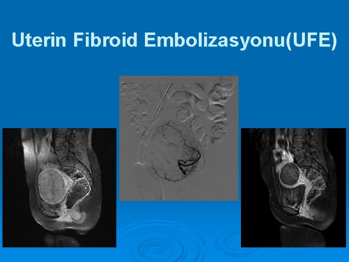 Uterin Fibroid Embolizasyonu(UFE) 