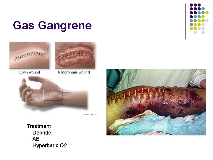 Gas Gangrene Treatment Debride AB Hyperbaric O 2 
