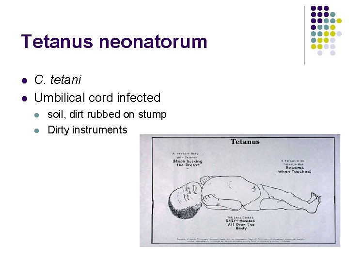 Tetanus neonatorum l l C. tetani Umbilical cord infected l l soil, dirt rubbed