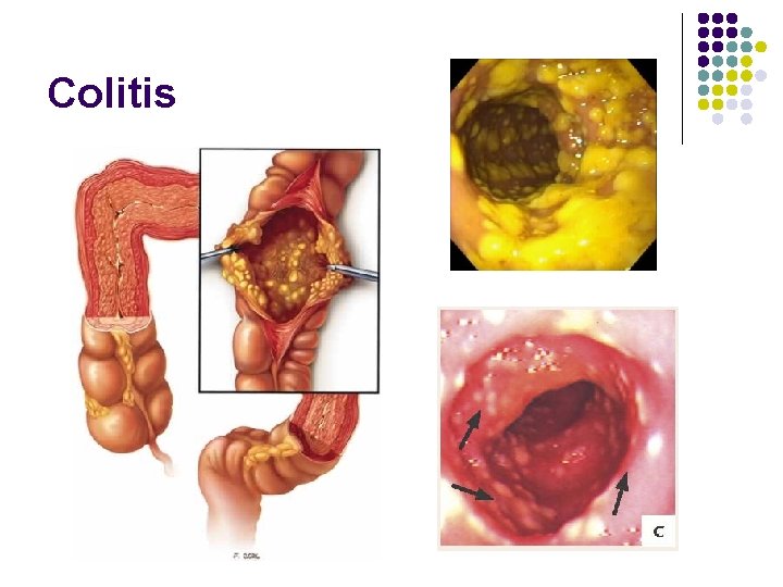 Colitis 