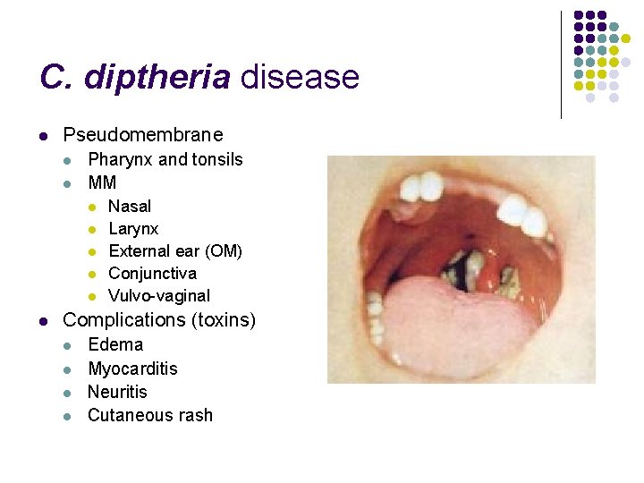 C. diptheria disease l Pseudomembrane l l Pharynx and tonsils MM l l l