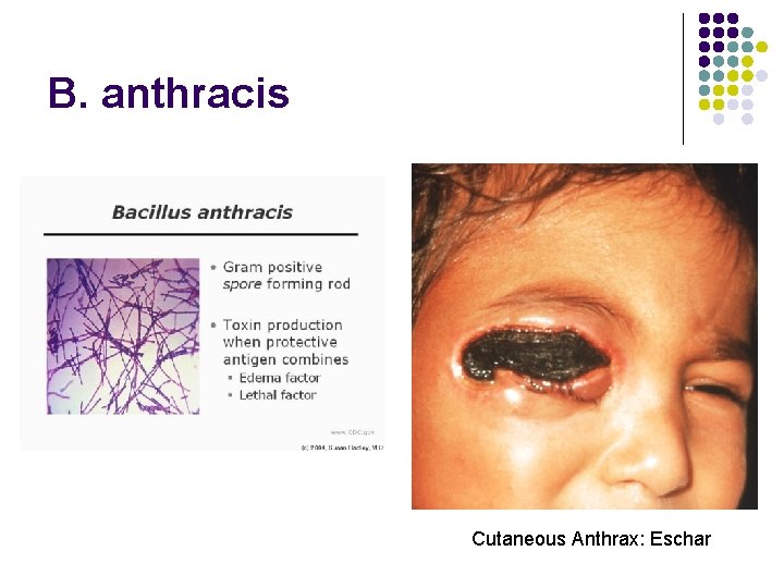 B. anthracis Cutaneous Anthrax: Eschar 