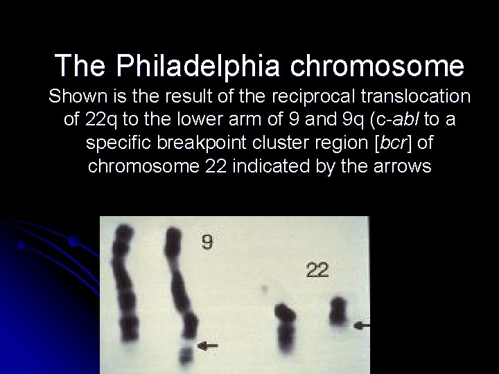 The Philadelphia chromosome Shown is the result of the reciprocal translocation of 22 q