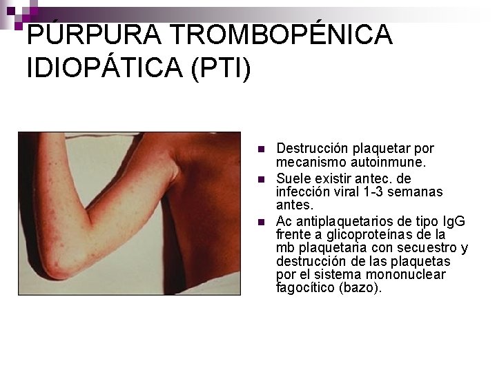 PÚRPURA TROMBOPÉNICA IDIOPÁTICA (PTI) n n n Destrucción plaquetar por mecanismo autoinmune. Suele existir