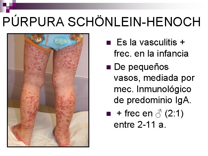 PÚRPURA SCHÖNLEIN-HENOCH Es la vasculitis + frec. en la infancia n De pequeños vasos,