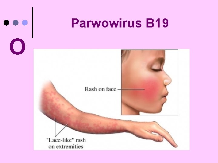 Parwowirus B 19 O 