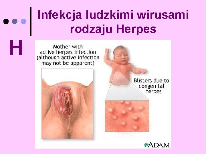 Infekcja ludzkimi wirusami rodzaju Herpes H 