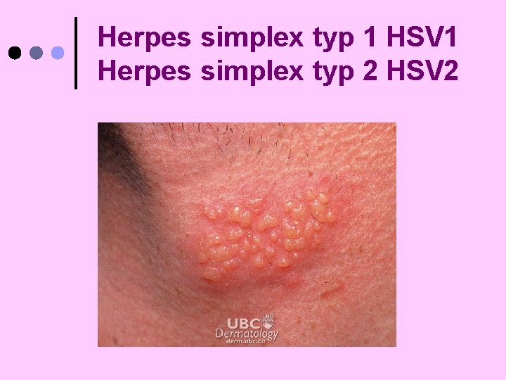 Herpes simplex typ 1 HSV 1 Herpes simplex typ 2 HSV 2 