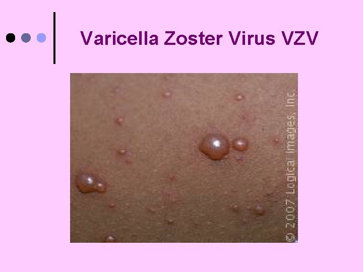 Varicella Zoster Virus VZV 