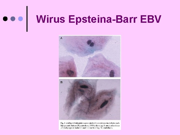 Wirus Epsteina-Barr EBV 