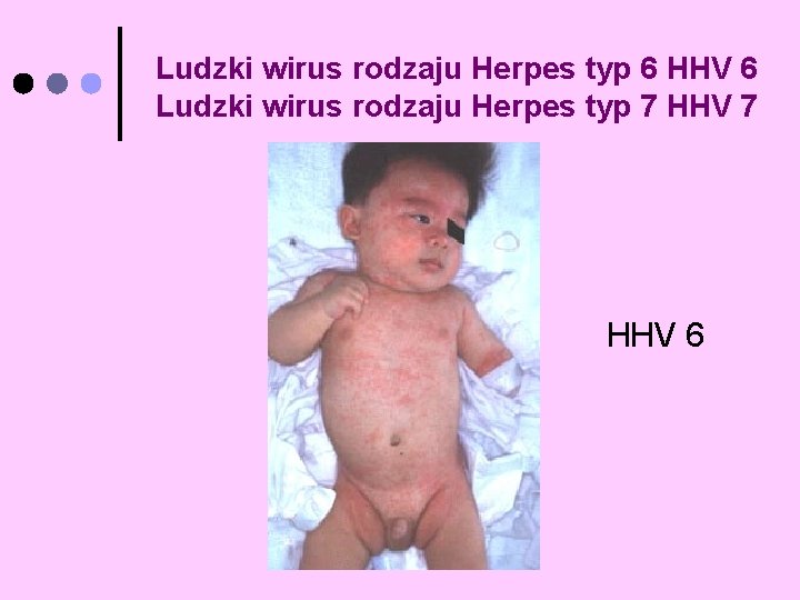 Ludzki wirus rodzaju Herpes typ 6 HHV 6 Ludzki wirus rodzaju Herpes typ 7