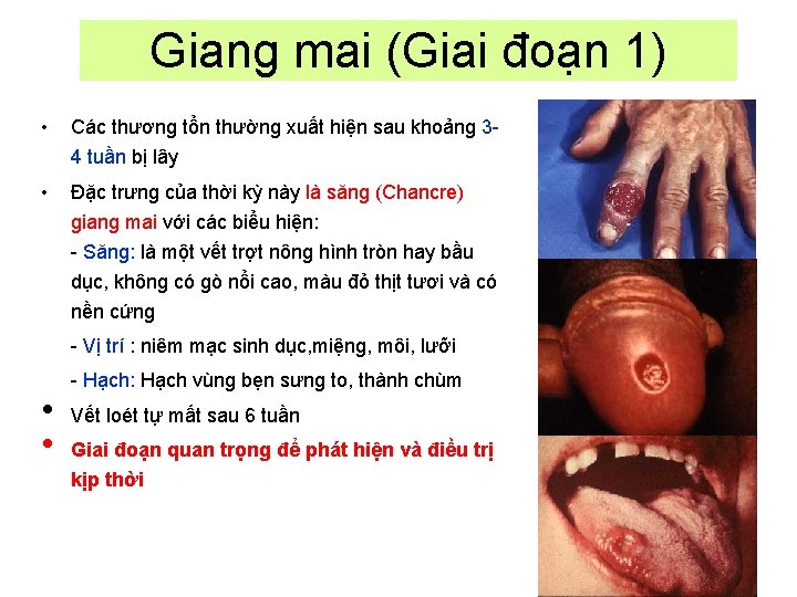 Giang mai (Giai đoạn 1) • Các thương tổn thường xuất hiện sau khoảng