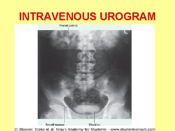 INTRAVENOUS UROGRAM 