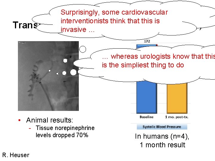 Verve Surprisingly, some cardiovascular interventionists think that this is Transurethral denervation (Radiofrequency) invasive …