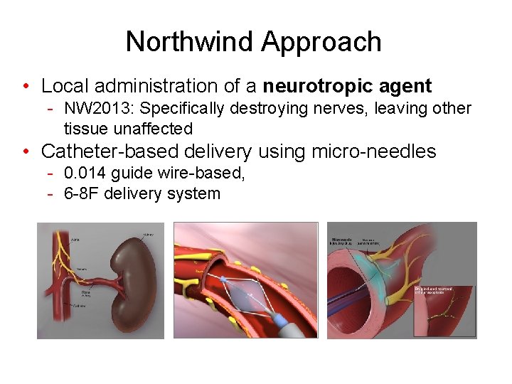 Northwind Approach • Local administration of a neurotropic agent - NW 2013: Specifically destroying