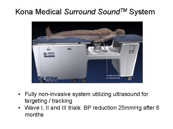 Kona Medical Surround Sound. TM System • Fully non-invasive system utilizing ultrasound for targeting