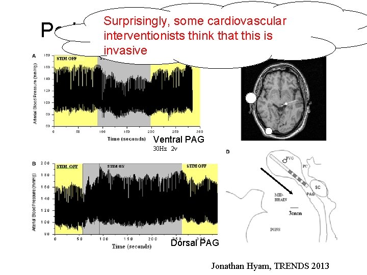 Surprisingly, some cardiovascular interventionists think that this is invasive Periaqueductal gray stimulation Ventral PAG
