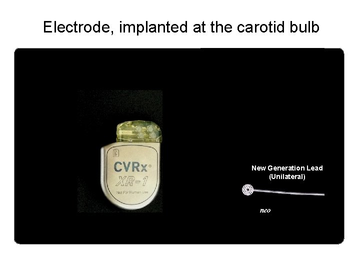 Electrode, implanted at the carotid bulb New Generation Lead (Unilateral) neo 