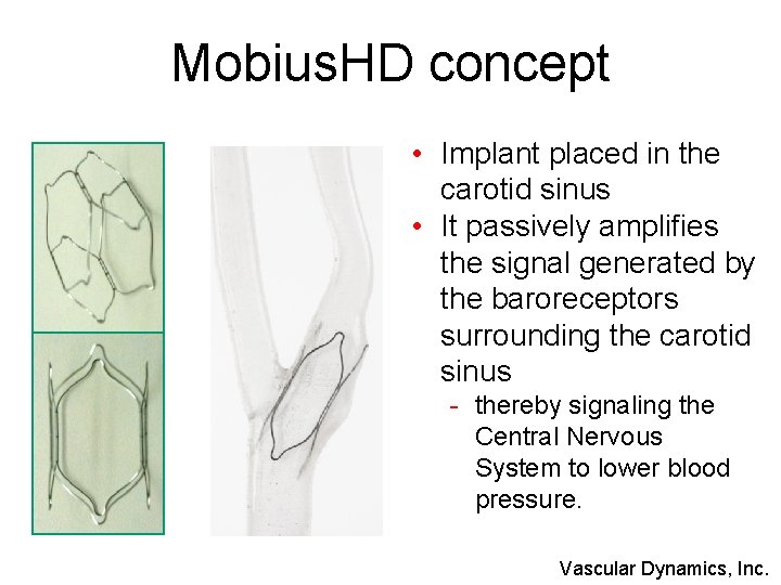Mobius. HD concept • Implant placed in the carotid sinus • It passively amplifies