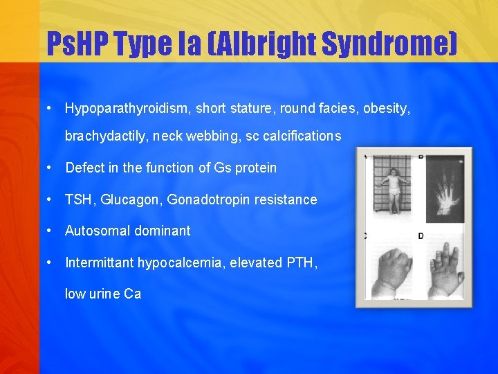 Ps. HP Type Ia (Albright Syndrome) • Hypoparathyroidism, short stature, round facies, obesity, brachydactily,