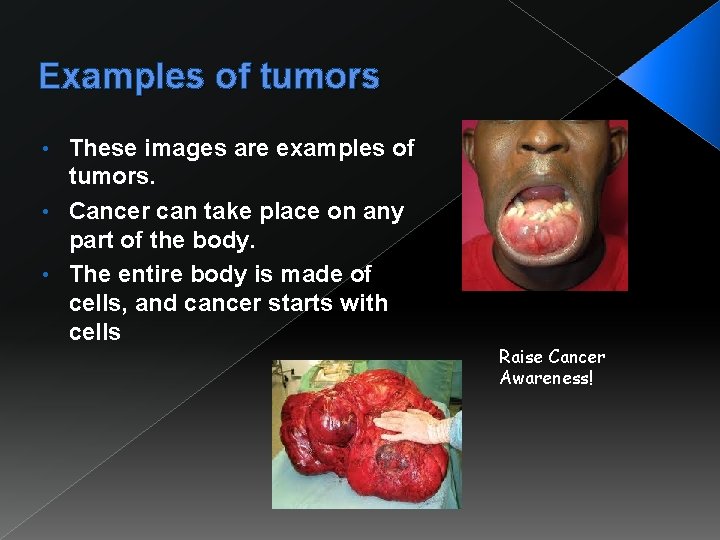 Examples of tumors These images are examples of tumors. • Cancer can take place