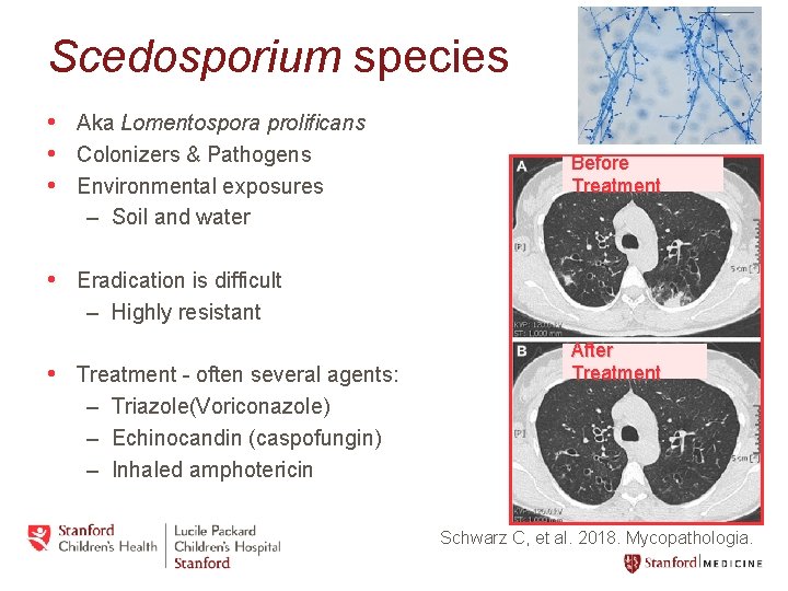 Scedosporium species • Aka Lomentospora prolificans • Colonizers & Pathogens • Environmental exposures Before