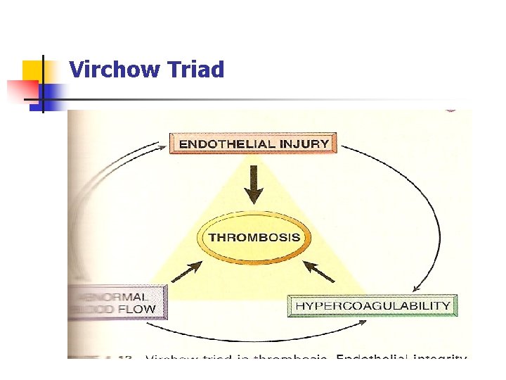 Virchow Triad 
