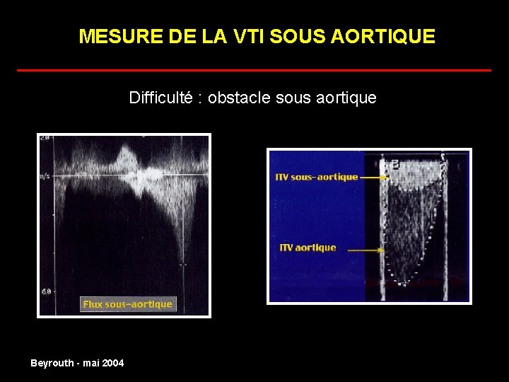 MESURE DE LA VTI SOUS AORTIQUE ______________________ Difficulté : obstacle sous aortique normal Beyrouth