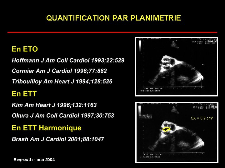 QUANTIFICATION PAR PLANIMETRIE ______________________ SA = 0, 9 cm² normal Beyrouth - mai 2004