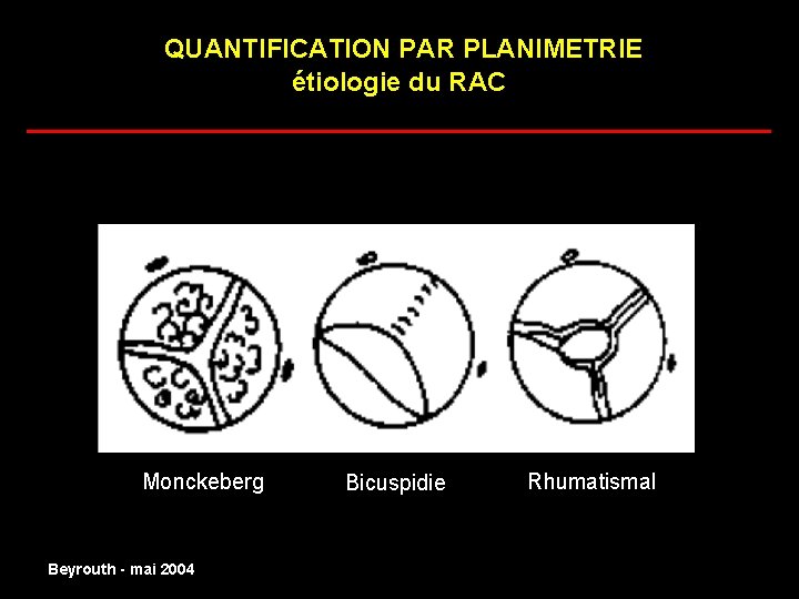 QUANTIFICATION PAR PLANIMETRIE étiologie du RAC ______________________ normal Monckeberg Beyrouth - mai 2004 Bicuspidie