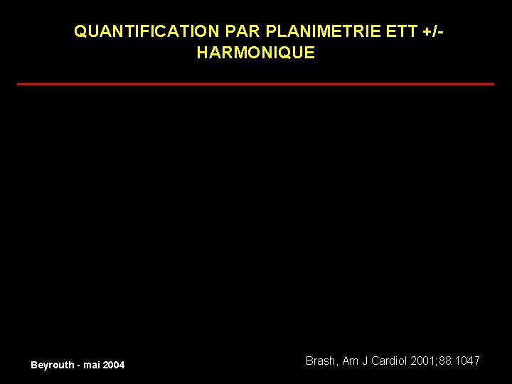 QUANTIFICATION PAR PLANIMETRIE ETT +/HARMONIQUE ______________________ normal Beyrouth - mai 2004 Brash, Am J