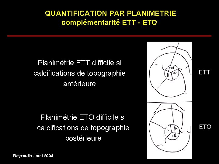 QUANTIFICATION PAR PLANIMETRIE complémentarité ETT - ETO ______________________ Planimétrie ETT difficile si calcifications de