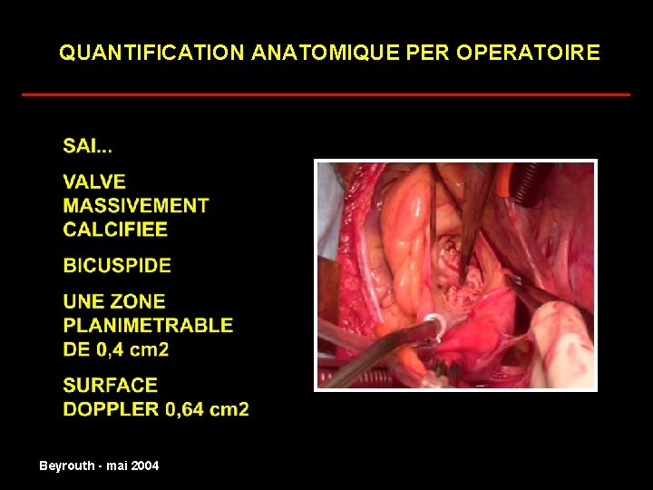 QUANTIFICATION ANATOMIQUE PER OPERATOIRE ______________________ normal Beyrouth - mai 2004 