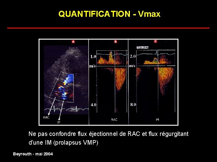 QUANTIFICATION - Vmax ______________________ normal Ne pas confondre flux éjectionnel de RAC et flux