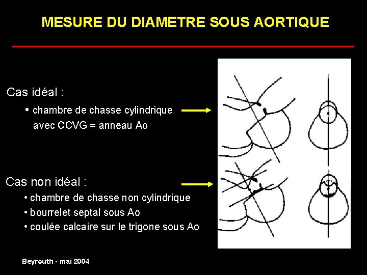 MESURE DU DIAMETRE SOUS AORTIQUE ______________________ Cas idéal : • chambre de chasse cylindrique