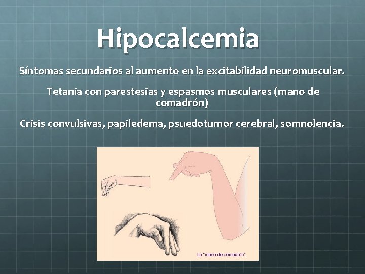 Hipocalcemia Síntomas secundarios al aumento en la excitabilidad neuromuscular. Tetania con parestesias y espasmos