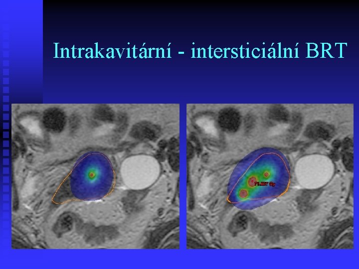 Intrakavitární - intersticiální BRT 